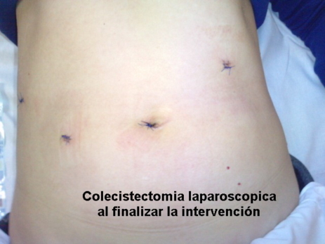 Cicatrizes De Colecistectomia Laparoscopica O Que Voc Deve Saber Cicatrizes De Colecistectomia Laparoscopica O Que Voc Deve Saber